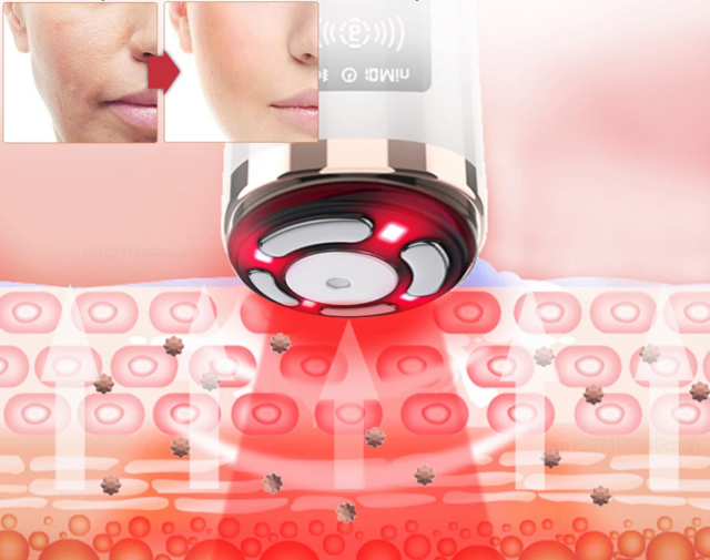 Mini Hifu Ultrassom Portátil Microfocado Para O Rosto