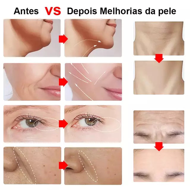 Mini Hifu Ultrassom Portátil Microfocado Para O Rosto